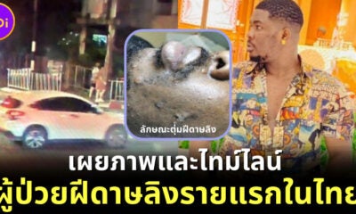 ชายไนจีเรีย ผู้ป่วยฝีดาษลิงรายแรกในไทย