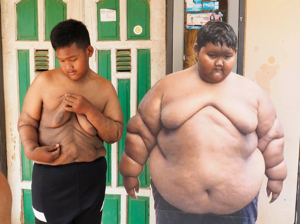 ภาพเทียบ เด็กอ้วนที่สุดในโลก