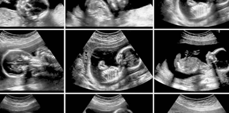 ภาพอัลตร้าซาวด์ทารกในครรภ์