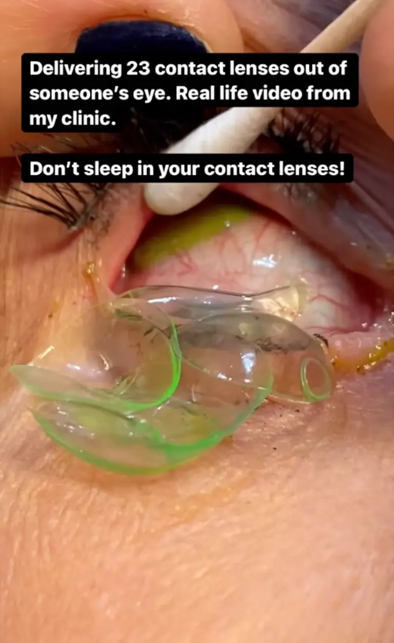 contact lens 3