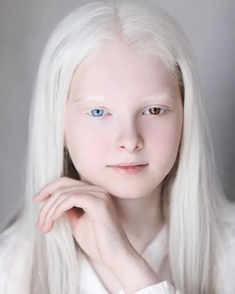 เผย 5 ผู้หญิงสวยจากพันธุกรรมที่หายากที่สุดในโลก