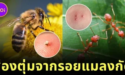 พาส่อง 12 รอยแมลงกัด ตุ่มที่เห็นขึ้นบนร่างกาย มาจากสัตว์อะไร? พร้อมวิธีดูแลเบื้องต้น