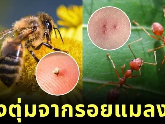 พาส่อง 12 รอยแมลงกัด ตุ่มที่เห็นขึ้นบนร่างกาย มาจากสัตว์อะไร? พร้อมวิธีดูแลเบื้องต้น