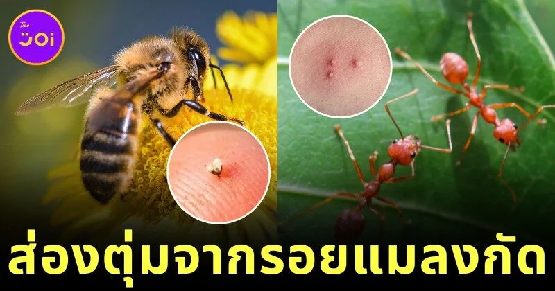 พาส่อง 12 รอยแมลงกัด ตุ่มที่เห็นขึ้นบนร่างกาย มาจากสัตว์อะไร? พร้อมวิธีดูแลเบื้องต้น