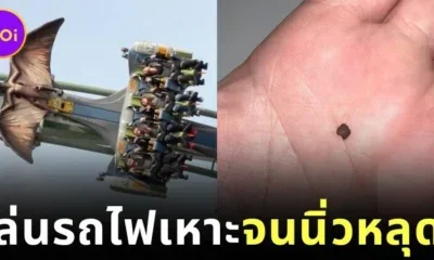 ชายจีนเล่นรถไฟเหาะ 3 รอบ… จนนิ่วในไตหลุด?! หมอย้ำ "อย่าเลียนแบบ" แม้ผลลัพธ์จะน่าทึ่งก็ตาม
